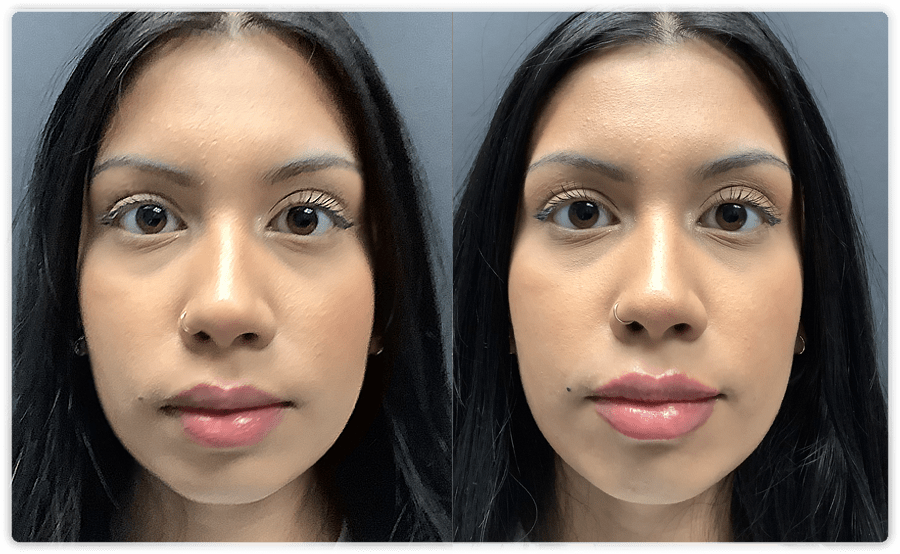 Lip Filler Augmentation Treatments In Toronto & Mississauga | Lip Doctor